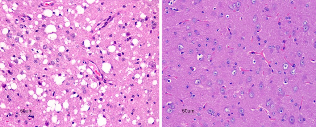 Of these two photomicrographs of a mouse brain , which do you think has a spongiform encephalopathy?